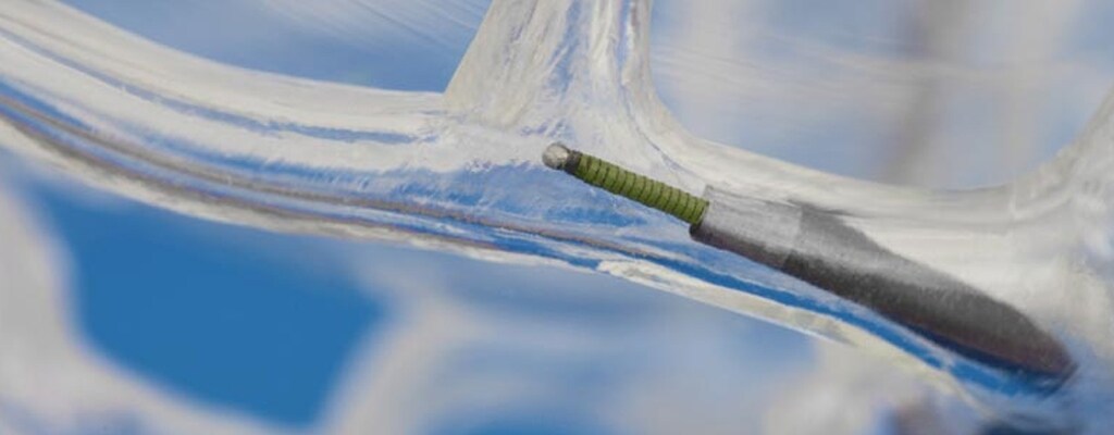 导丝设计的全新视角